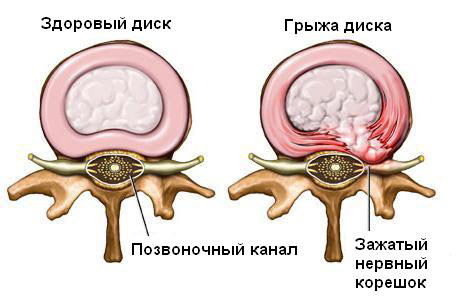 Грижі міжхребцевих дисків фото